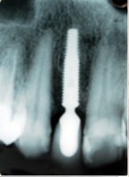 /album/galeria-de-fotos-carga-imediata-apos-exodontia-atraumatica-/carga-imediata-com-exodontia-atraumatica23-jpg/